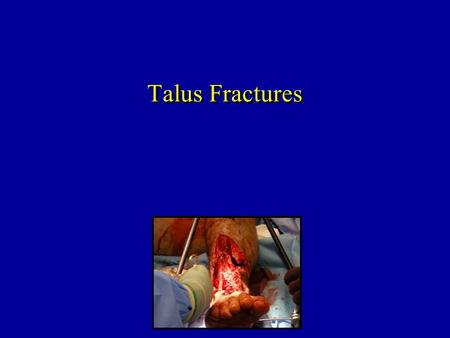 Talus Fractures.