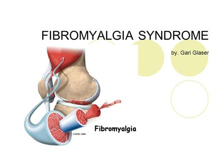 FIBROMYALGIA SYNDROME by. Gari Glaser. What is Fibromyalgia? It is defined as a widespread musculoskeletal pain and fatigue disorder for which the cause.
