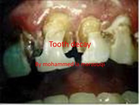 Tooth decay By mohammed la marzouqi. What is tooth decay. Decay is the destruction of tooth structure. Decay occurs when plaque, the sticky substance.