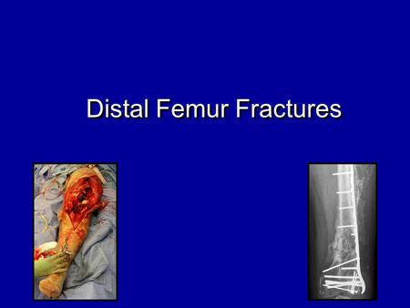 Distal Femur Fractures