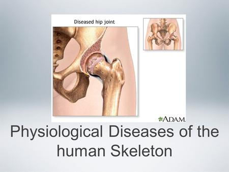 Physiological Diseases of the human Skeleton. Inflammatory Disorders of joints Joint pain and discomfort can be caused by many factors Bursitis Arthritis.