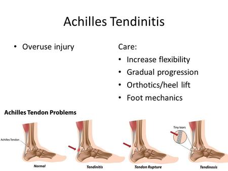 Achilles Tendinitis Overuse injuryCare: Increase flexibility Gradual progression Orthotics/heel lift Foot mechanics.