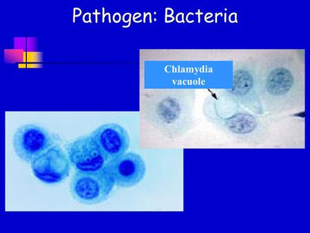 Pathogen: Bacteria Chlamydia vacuole. Chlamydia – Sterility - infected ovaries and fallopian tubes Normal Abnormal.