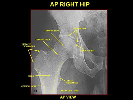 AP RIGHT HIP AP VIEW RT. ACETABULUM FEMORAL HEAD FEMORAL NECK