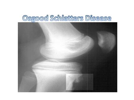 What is it? Osgood Schlatters disease is a very common cause of knee pain in children and young athletes usually between the ages of 10 and 15. It occurs.