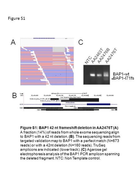 Figure S1: BAP1 42 nt frameshift deletion in AA2476T (A) A fraction (14%) of reads from whole exome sequencing align to BAP1 with a 42 nt deletion. (B).