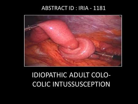 IDIOPATHIC ADULT COLO- COLIC INTUSSUSCEPTION