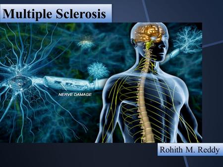 Multiple Sclerosis Rohith M. Reddy. Multiple sclerosis (MS) involves an immune-mediated process in which an abnormal response of the body’s immune system.