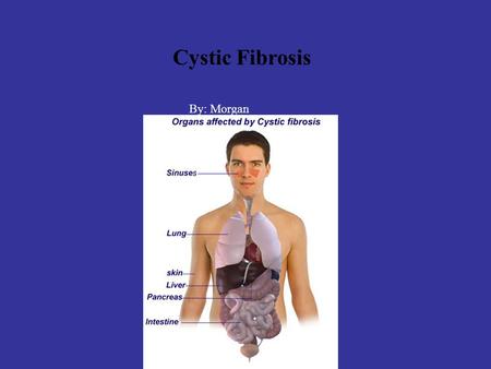 Cystic Fibrosis By: Morgan. Definition Cystic fibrosis is a thick mucus that clogs the air ways and tends to cause lung diseases. A diseases common among.
