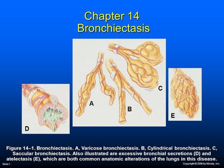 Chapter 14 Bronchiectasis