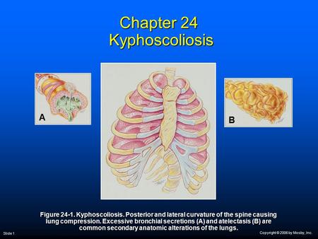 Chapter 24 Kyphoscoliosis