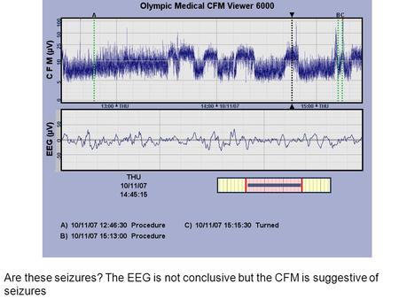 Are these seizures? The EEG is not conclusive but the CFM is suggestive of seizures.