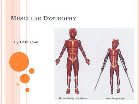 M USCULAR D YSTROPHY By: Collin Lowe. C AUSES Muscular Dystrophy is inherited in an X-linked recessive pattern, meaning that the mutated gene that causes.