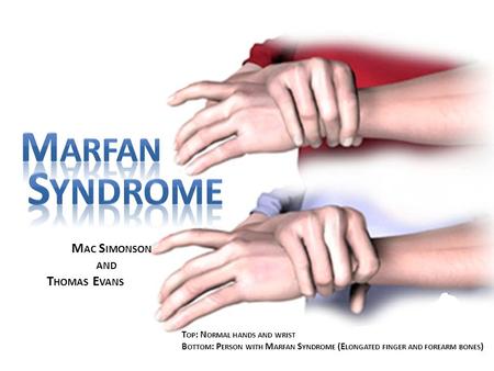 Syndrome Marfan Mac Simonson and Thomas Evans