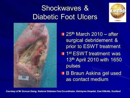 Shockwaves & Diabetic Foot Ulcers 25 th March 2010 – after surgical debridement & prior to ESWT treatment 1 st ESWT treatment was 13 th April 2010 with.