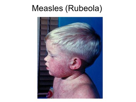 Measles (Rubeola).