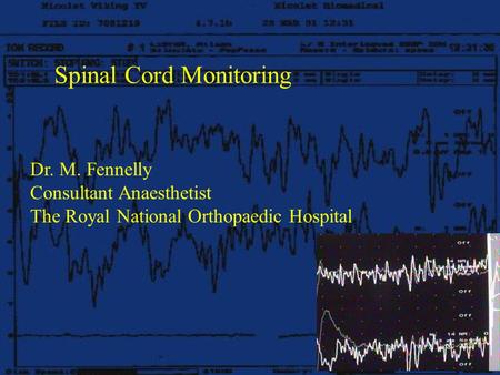 Spinal Cord Monitoring