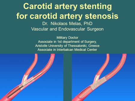Carotid artery stenting for carotid artery stenosis Dr. Nikolaos Melas, PhD Vascular and Endovascular Surgeon Military Doctor Associate in 1st department.
