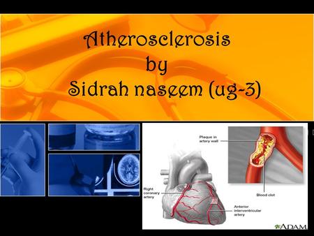 Atherosclerosis by Sidrah naseem (ug-3). Arteries are blood vessels that carry oxygen and nutrients from your heart to the rest of your body. Healthy.