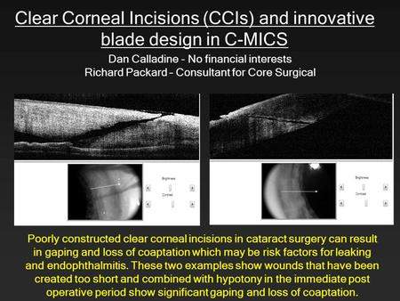 Clear Corneal Incisions (CCIs) and innovative blade design in C-MICS Dan Calladine - No financial interests Richard Packard – Consultant for Core Surgical.