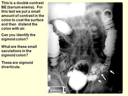 This is a double contrast BE (barium enema). For this test we put a small amount of contrast in the colon to coat the surface and then distend the colon.