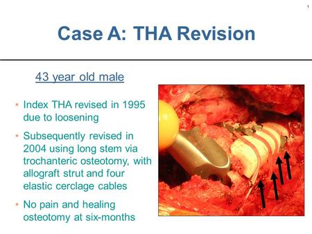 1 1 Case A: THA Revision 43 year old male Index THA revised in 1995 due to loosening Subsequently revised in 2004 using long stem via trochanteric osteotomy,