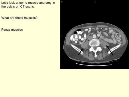 Let’s look at some muscle anatomy in the pelvis on CT scans. What are these muscles? Psoas muscles.