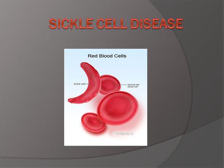 What is Sickle Cell Disease?  Sickle cell anemia (not having enough red blood cells) is a disease passed down from family to family that affects red.