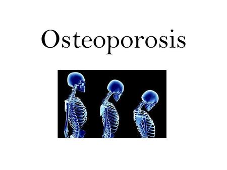 Osteoporosis. For todays presentation… We will be discussing Background of osteoporosis Definition Causes Pathology Epidemiology Treatments Meal Plan.
