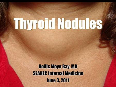 Thyroid Nodules Hollis Moye Ray, MD SEAHEC Internal Medicine June 3, 2011.