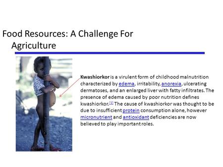 Food Resources: A Challenge For Agriculture Kwashiorkor is a virulent form of childhood malnutrition characterized by edema, irritability, anorexia, ulcerating.