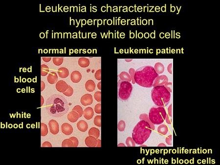 Leukemia is characterized by hyperproliferation of immature white blood cells white blood cell Leukemic patientnormal person red blood cells hyperproliferation.