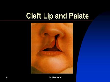 Cleft Lip and Palate Dr. Gutmann.