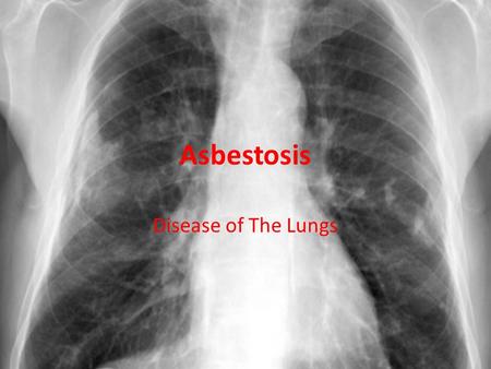 Asbestosis Disease of The Lungs. Causes By breathing in tiny fibers of asbestos, a heart resistant material that used to be common in insulation, vinyl.