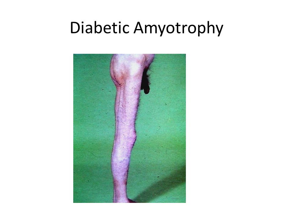 diabetic neuropathy emegoakor nonso