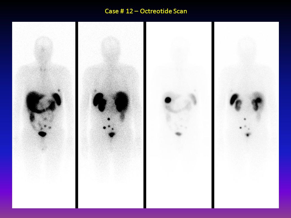 book carcinoma of the kidney