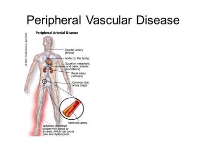 Peripheral Vascular Disease. Peripheral Artery Disease Peripheral Venous Disorders Carotid Artery Disease Peripheral Artery Disease Peripheral Renal Disease.