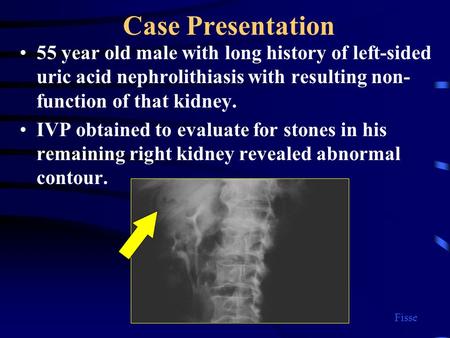Case Presentation 55 year old male with long history of left-sided uric acid nephrolithiasis with resulting non- function of that kidney. IVP obtained.