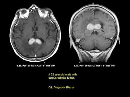 5.1b. Post-contrast Coronal T1 Wtd MRI5.1a. Post-contrast Axial T1 Wtd MRI A 52 year-old male with corpus callosal tumor. Q1. Diagnosis Please.