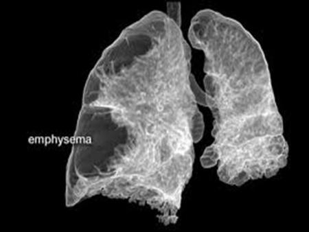 What Is Emphysema? Emphysema is a chronic lung condition in which the lungs' natural airspaces, called alveoli, become larger but decrease in number.