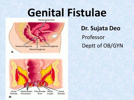 Genital Fistulae Dr. Sujata Deo Professor Deptt of OB/GYN.