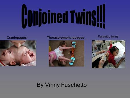 By Vinny Fuschetto CraniopagusThoraco-omphalopagus Parasitic twins.