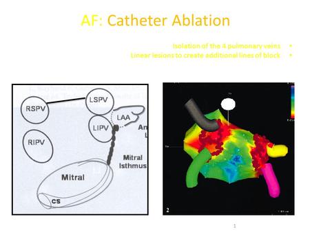AF: Catheter Ablation Isolation of the 4 pulmonary veins Linear lesions to create additional lines of block 1.