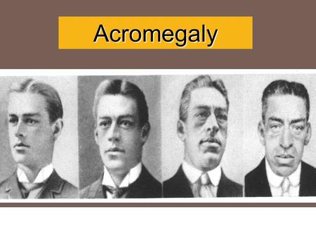 ACROMEGALY Acromegaly. it is a rare hormonal disorder that develops when the pituitary gland produces too much growth hormone.. Definition.