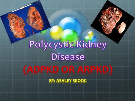 kidney damage seen in PKD is actually the result of the body's immune system Middle age or infancy Polycystic Kidney Disease (PKD), first reported in.