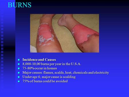 BURNS Incidence and Causes 8,000-10,00 burns per year in the U.S.A.