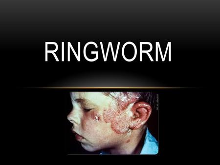 Ringworm.