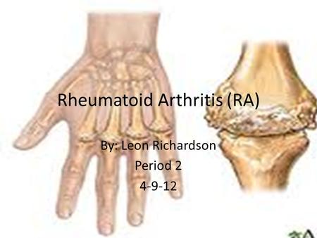 Rheumatoid Arthritis (RA) By: Leon Richardson Period 2 4-9-12.