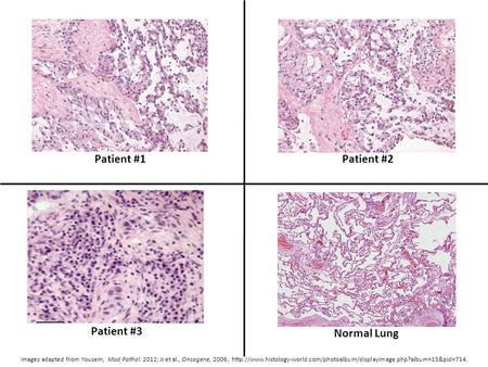 Patient #1 Images adapted from Yousem, Mod Pathol. 2012; Ji et al., Oncogene, 2006;