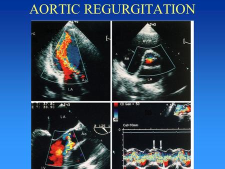 AORTIC REGURGITATION AORTIC REGURGITATION ETIOLOGY LEAFLETS: RHEUMATIC H.D. CALCIFIED PROLAPSE ENDOCARDITIS TRAUMA RHEUMATOID ARTHRITIS ANNULUS, ROOT.